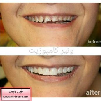 http://alferdousco.com/wp-content/uploads/Dental-composite-before-after.jpg