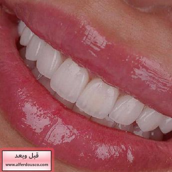 http://alferdousco.com/wp-content/uploads/Dental-laminate-IRAN.jpg