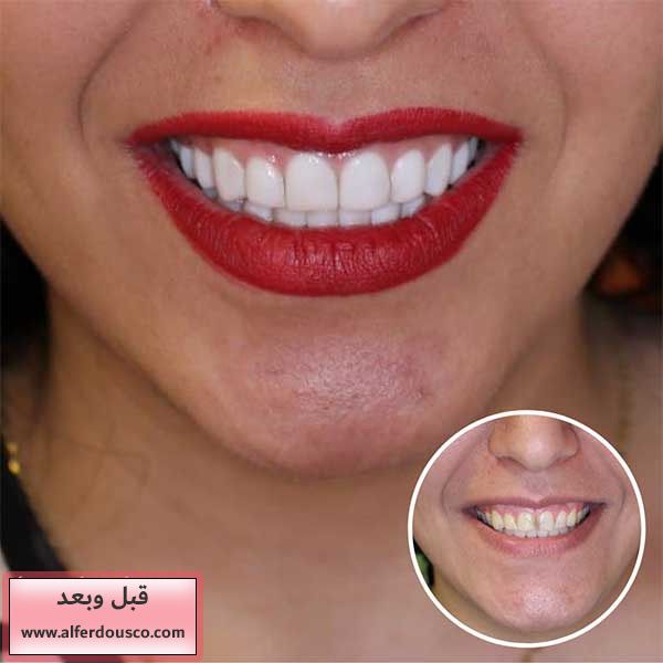 http://alferdousco.com/wp-content/uploads/composite-and-laminate-dental-difference.jpg